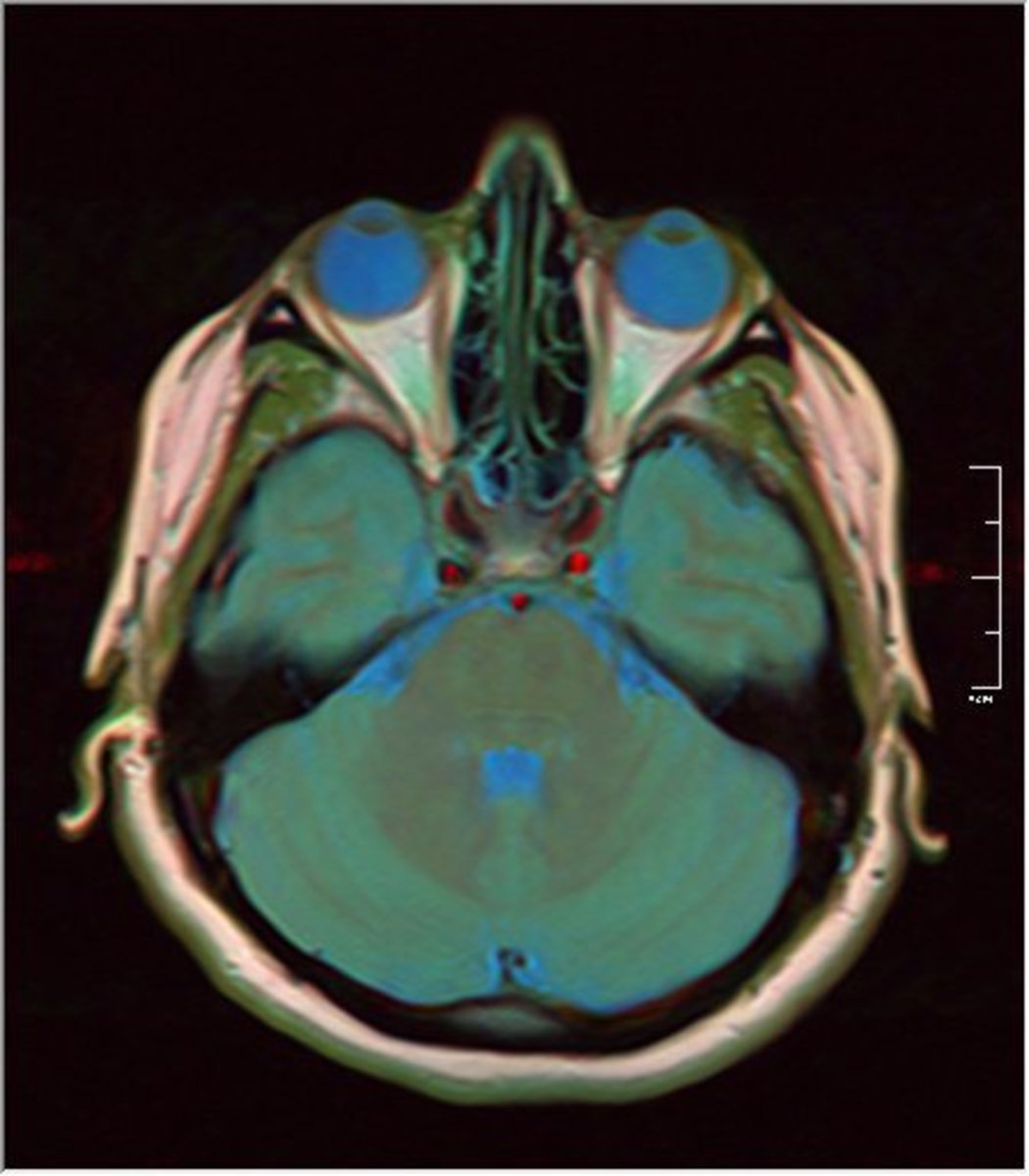 MRI of the Brain