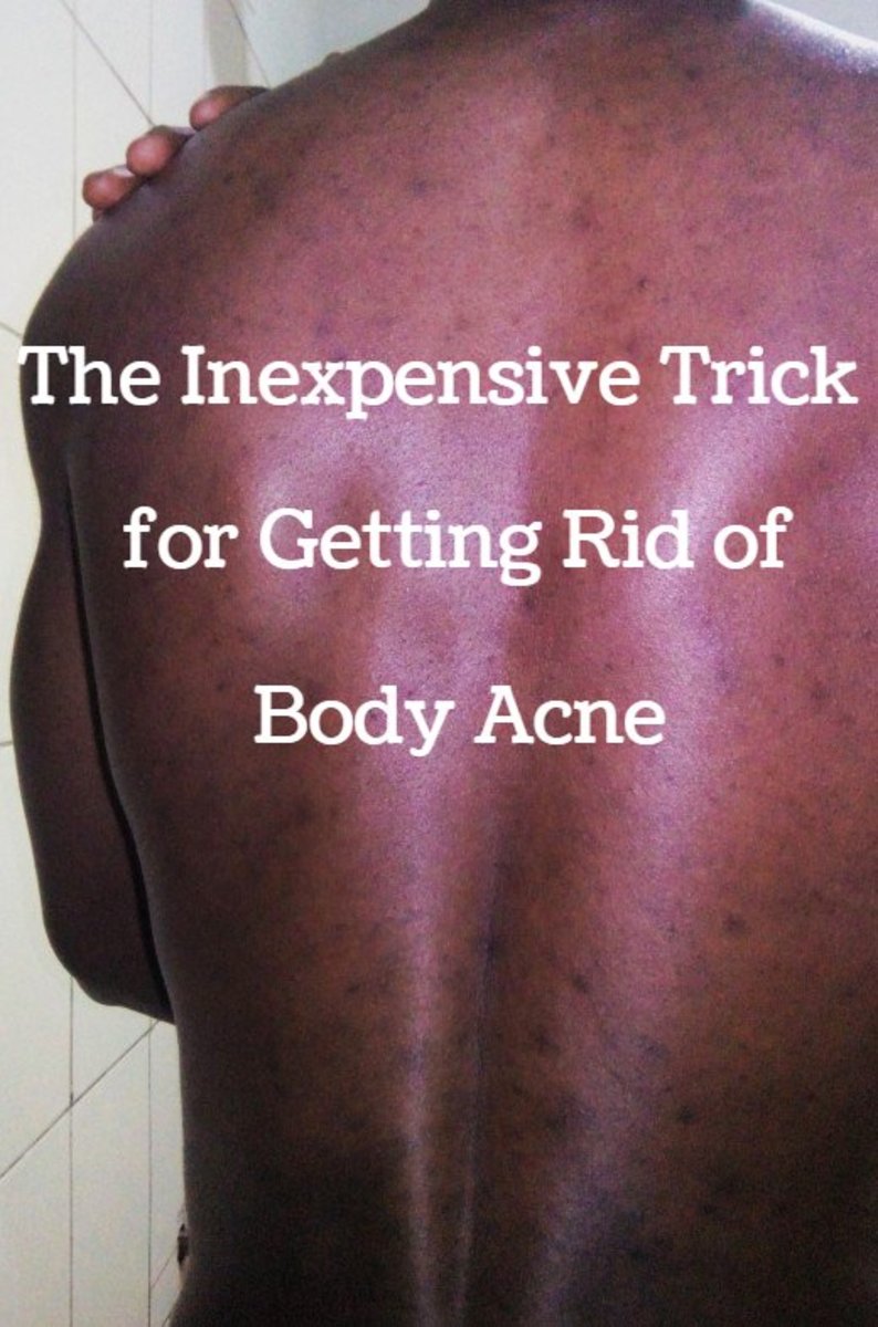 The Inexpensive Trick for Getting Rid of Body Acne