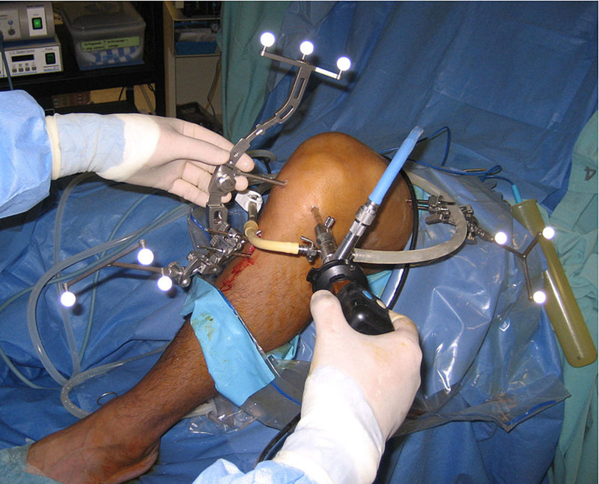 Arthroscopy of the Knee: The Tools Are Inserted Through Small Holes