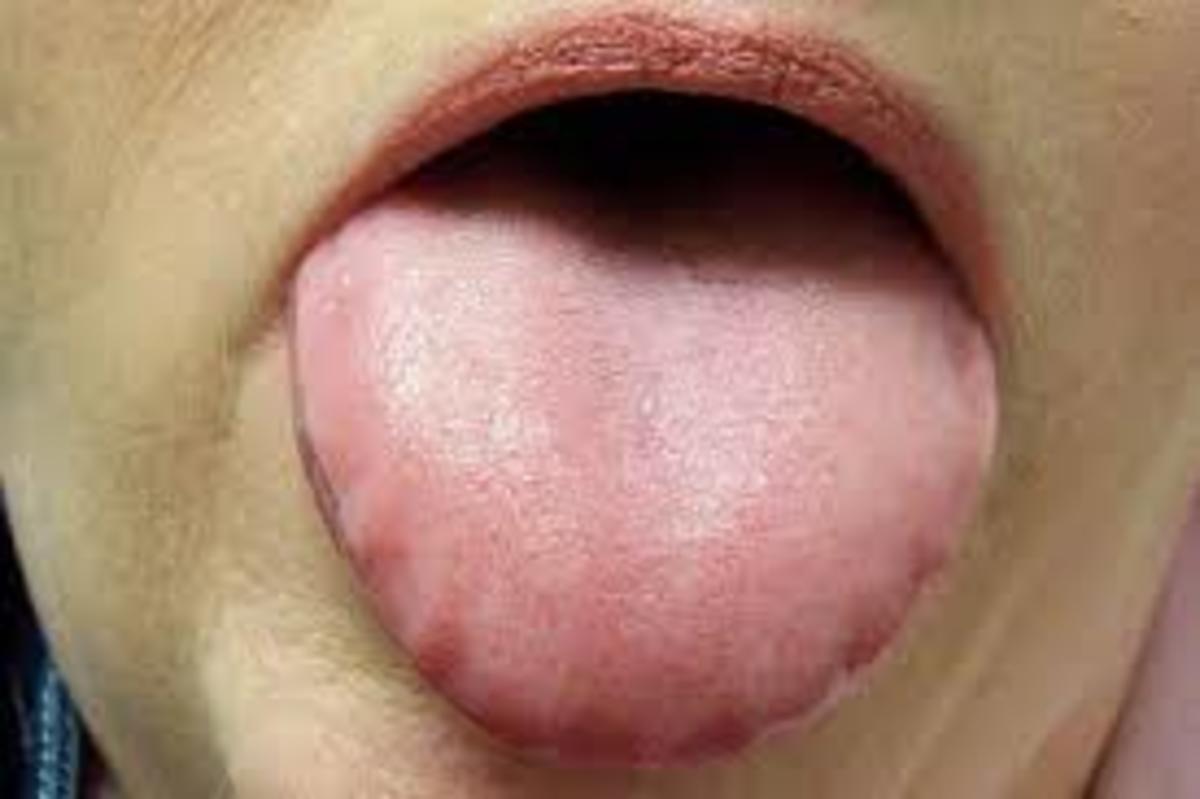A typical spleen qi deficient tongue is puffy or enlarged, thin to thick moist white coating, toothmarks on the edges, and pale color.