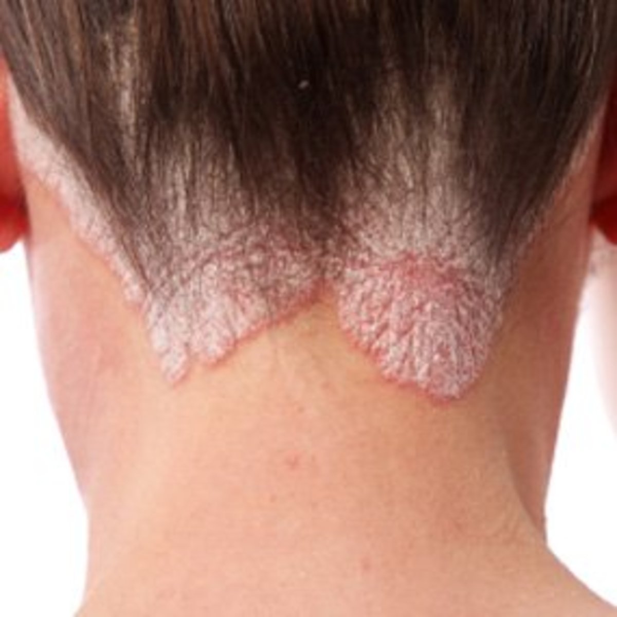 Scalp psoriasis may occur anywhere on the scalp. 