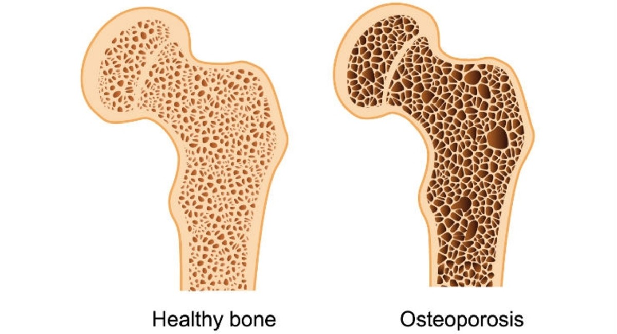 Why Chronic Stress Can Lead to Osteoporosis and How to Reverse the ...