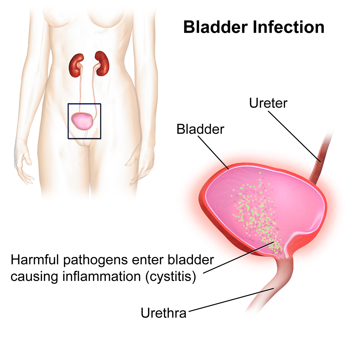 Home remedies for bladder infections.