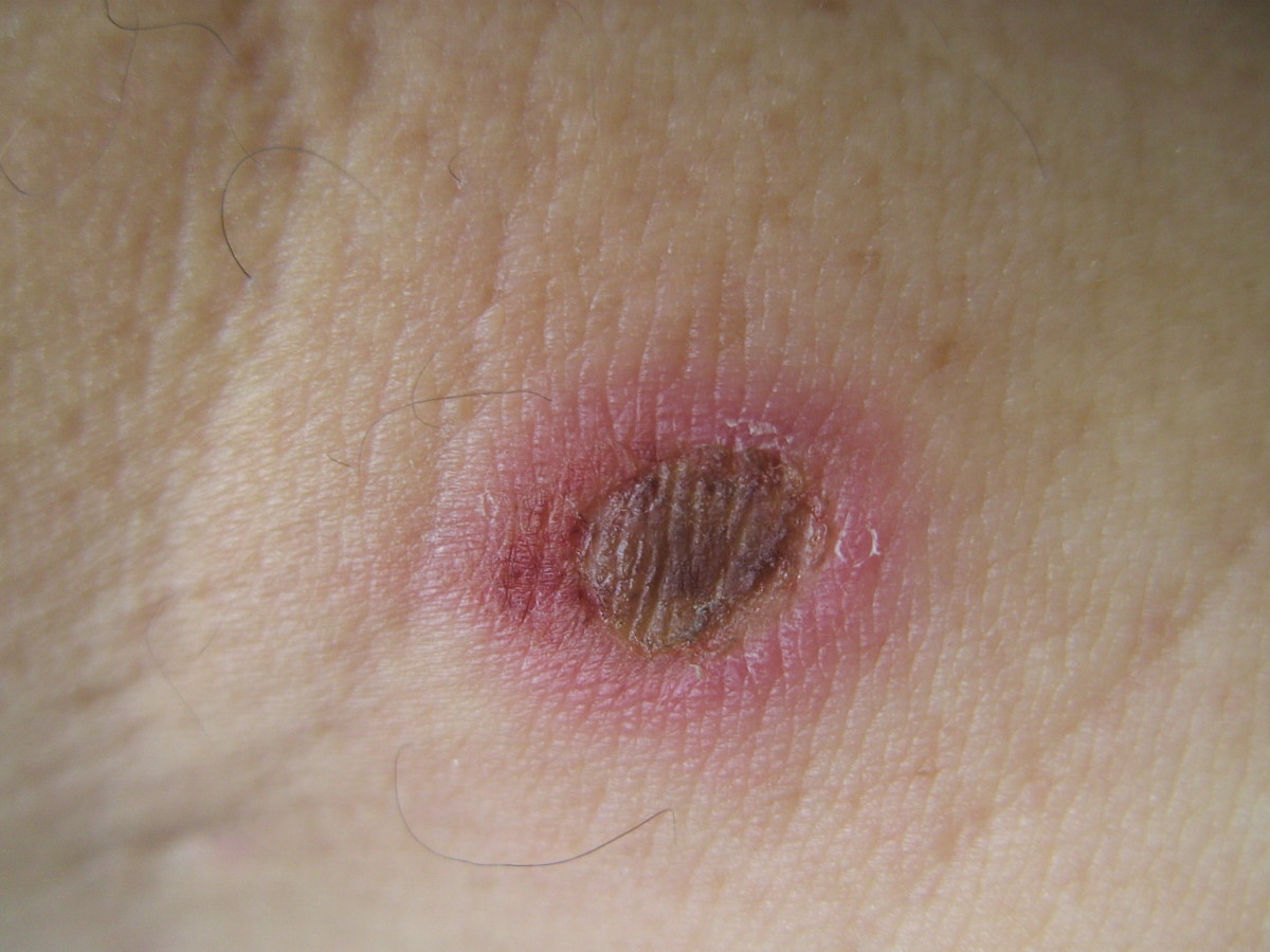 Home Remedies for First Degree Burns