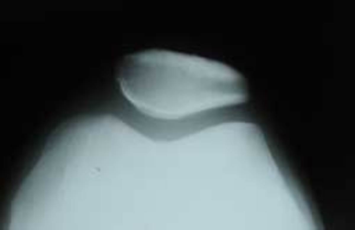 Looking between the thigh and the kneecap in a skyline view X-ray.