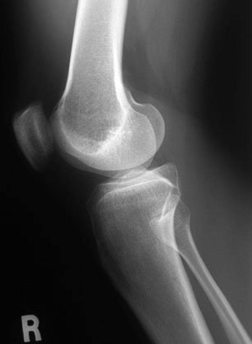 A lateral view X-ray shows the knee from the side.