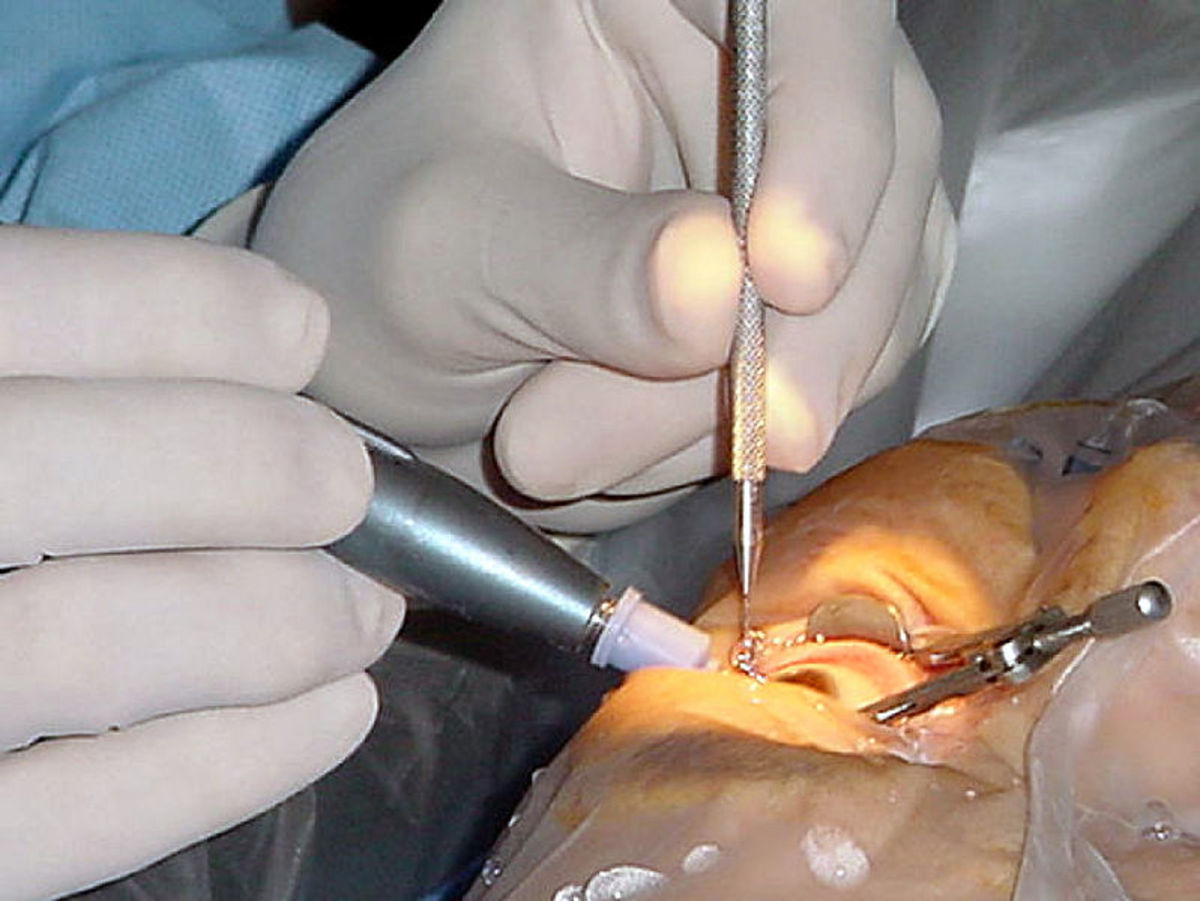 A surgeon performing cataract surgery.