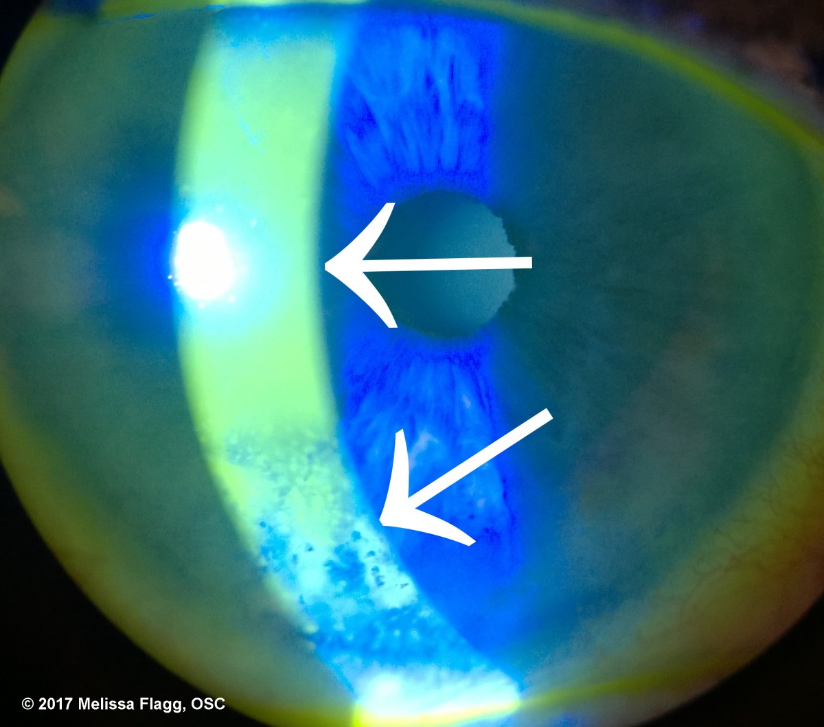 An image showing evaporative dry eye (bottom error) in a patient who does not close their eyes completely when sleeping. 