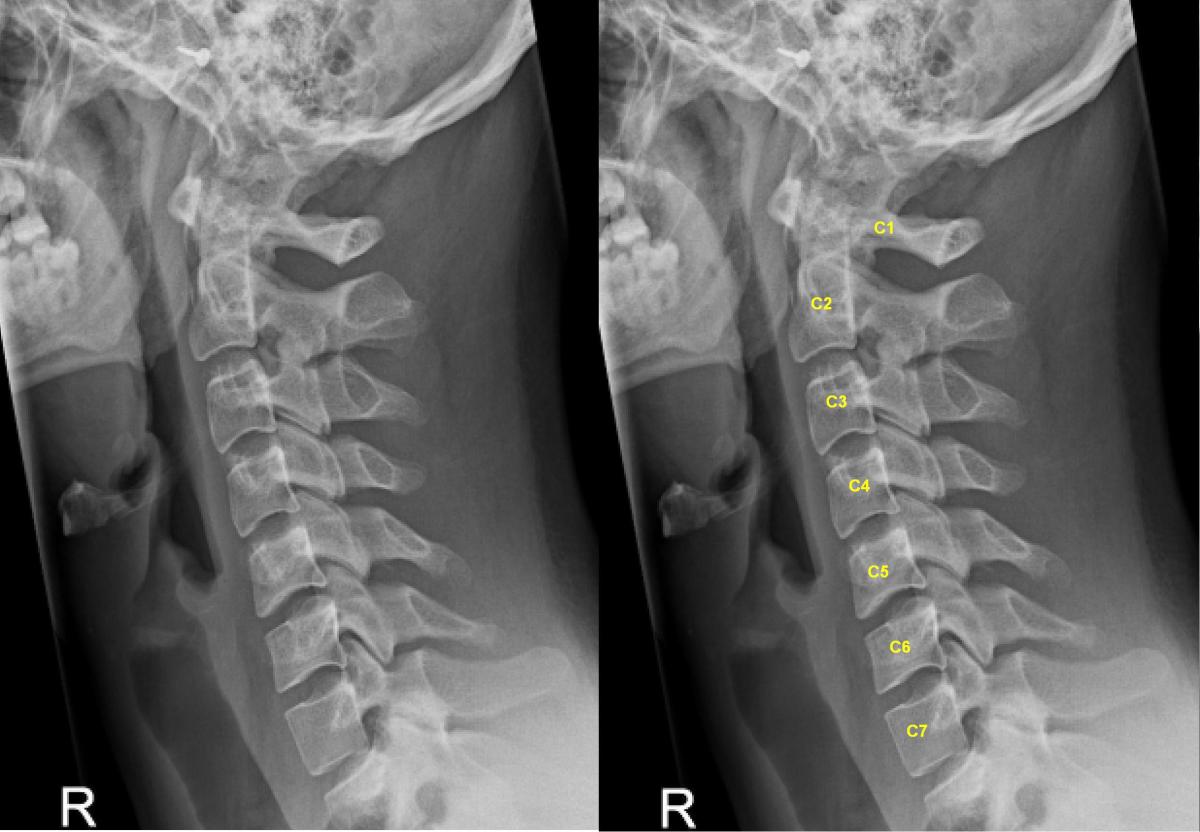 Lateral (from the side) X-ray of the cervical spine showing the number of the vertebrae, C1 to C7, which can be seen by clicking on the photo to enlarge it.