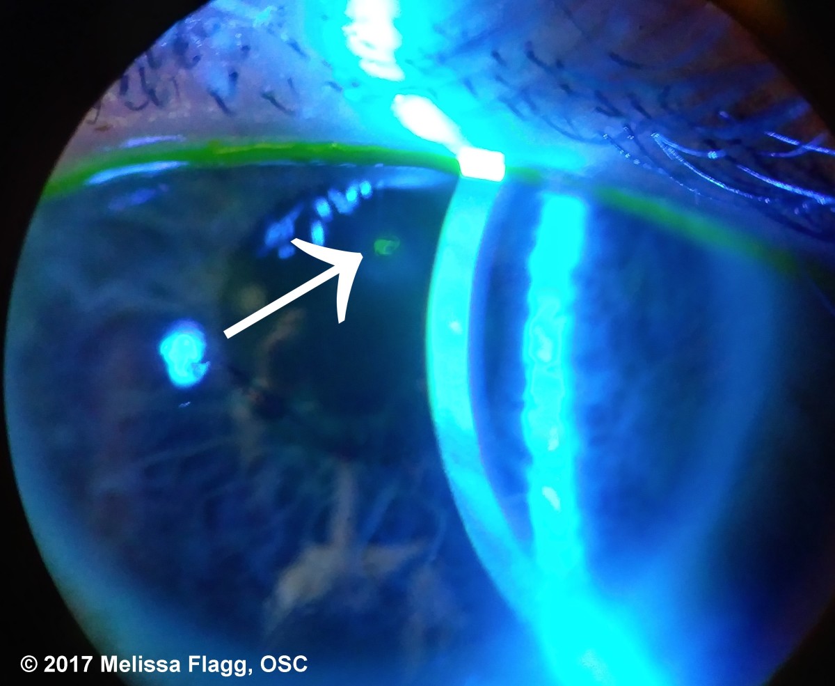 A residual abrasion seen three days after removing the above corneal foreign body from the auto mechanic. Used with permission.