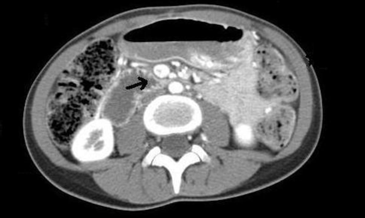 Abdominal and pelvic CT scan showing duodenal compression.