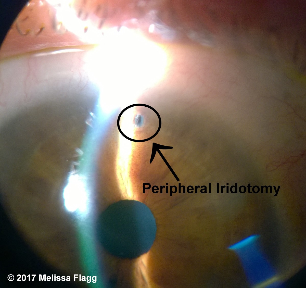 An image of a completed peripheral iridotomy.