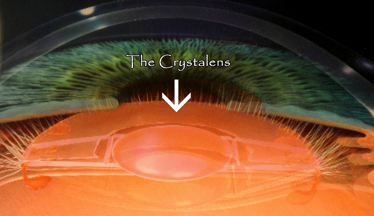 Image of the Crystalens