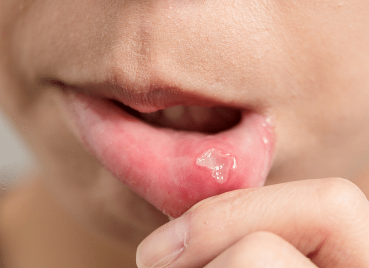 An aphthous ulcer (canker sore) is a normal finding.