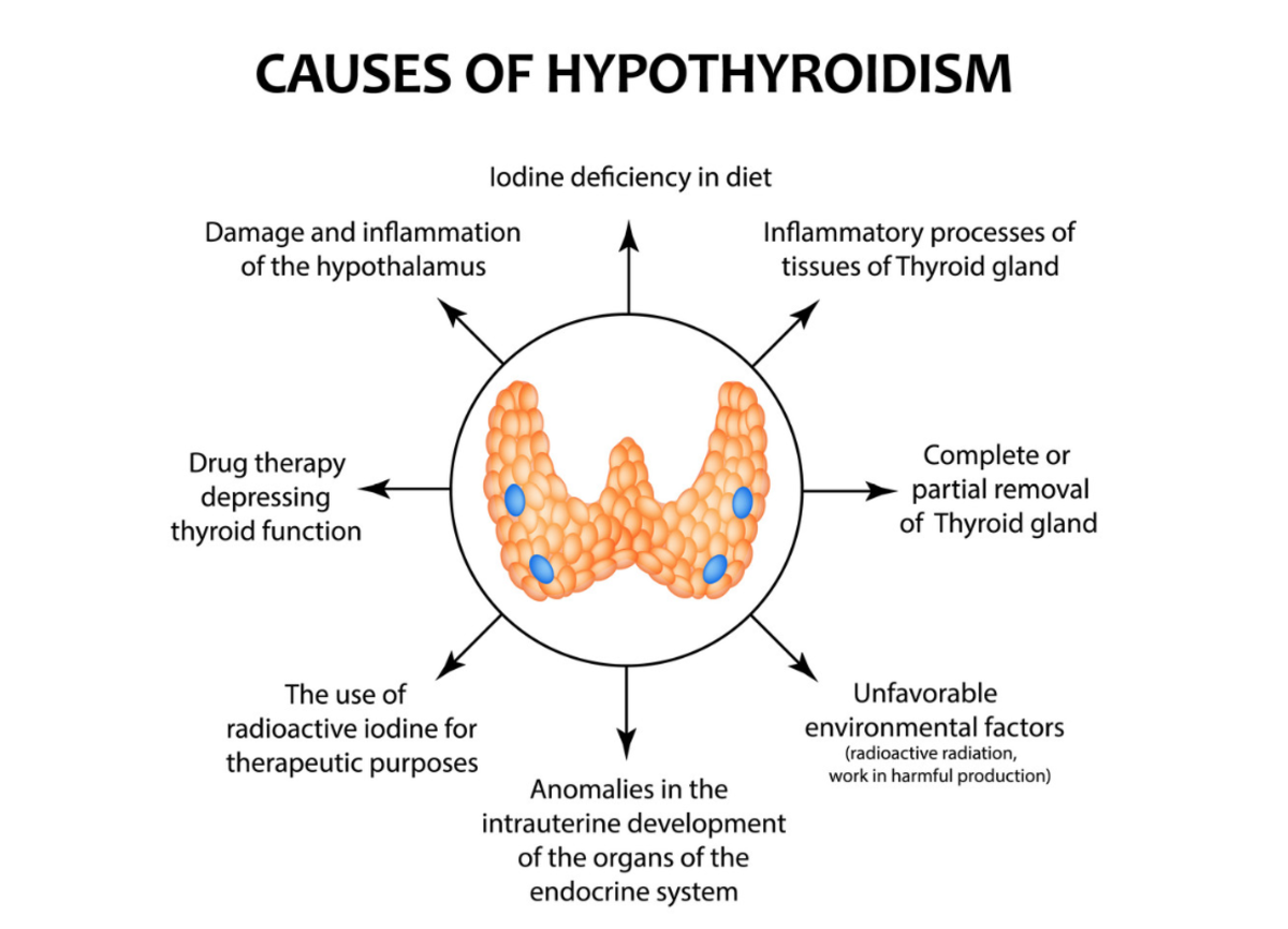 Causes of Hypothyroidism 