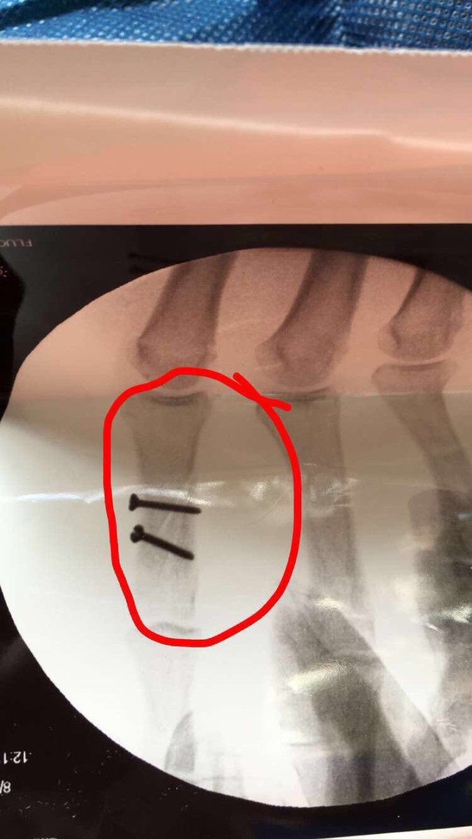 Fractured right (index) proximal phalanx. Two 3 millimeter screws were inserted during open reduction and internal fixation (ORIF) surgery.