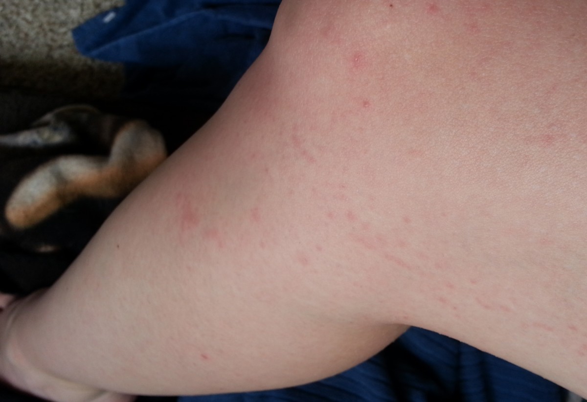 The rash on my leg, caused by Nair Hair Removal Lotion
