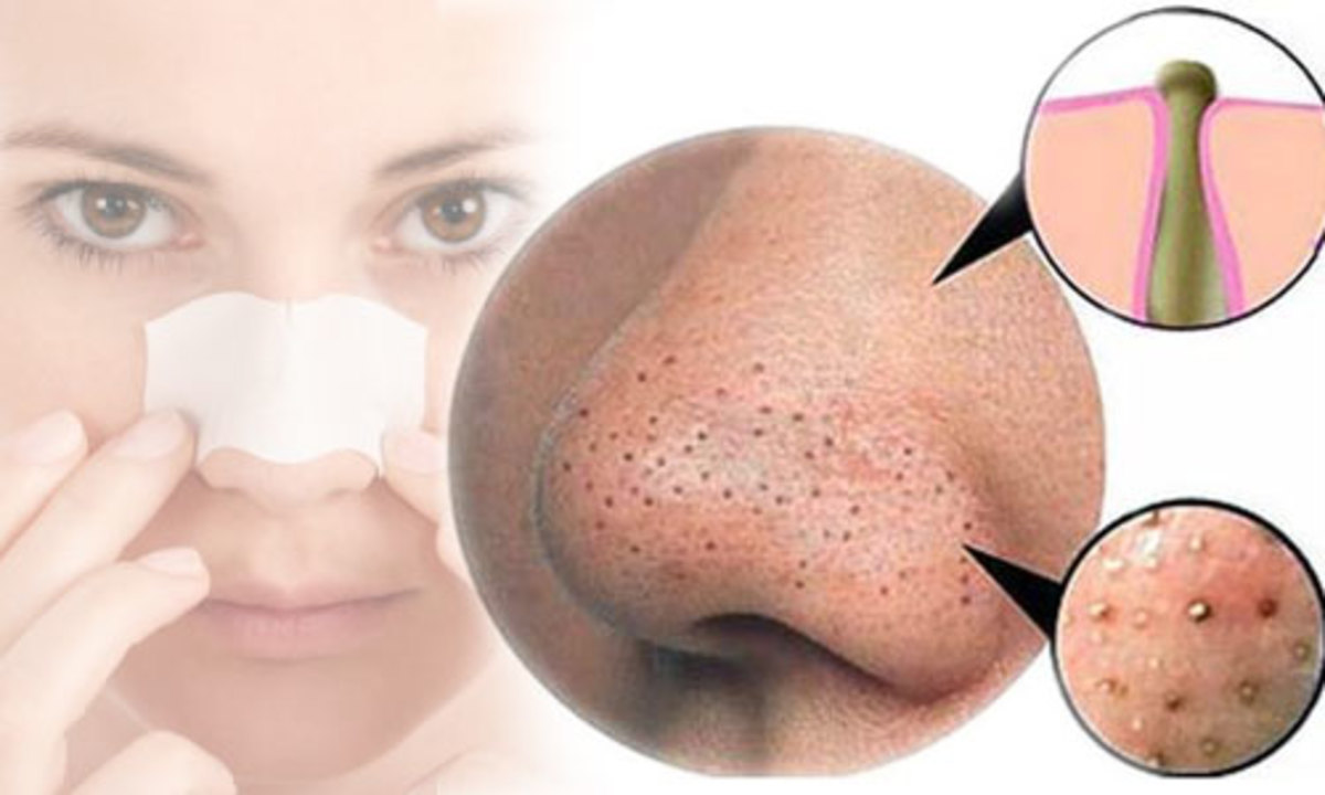 Blackheads and how to get clear skin.