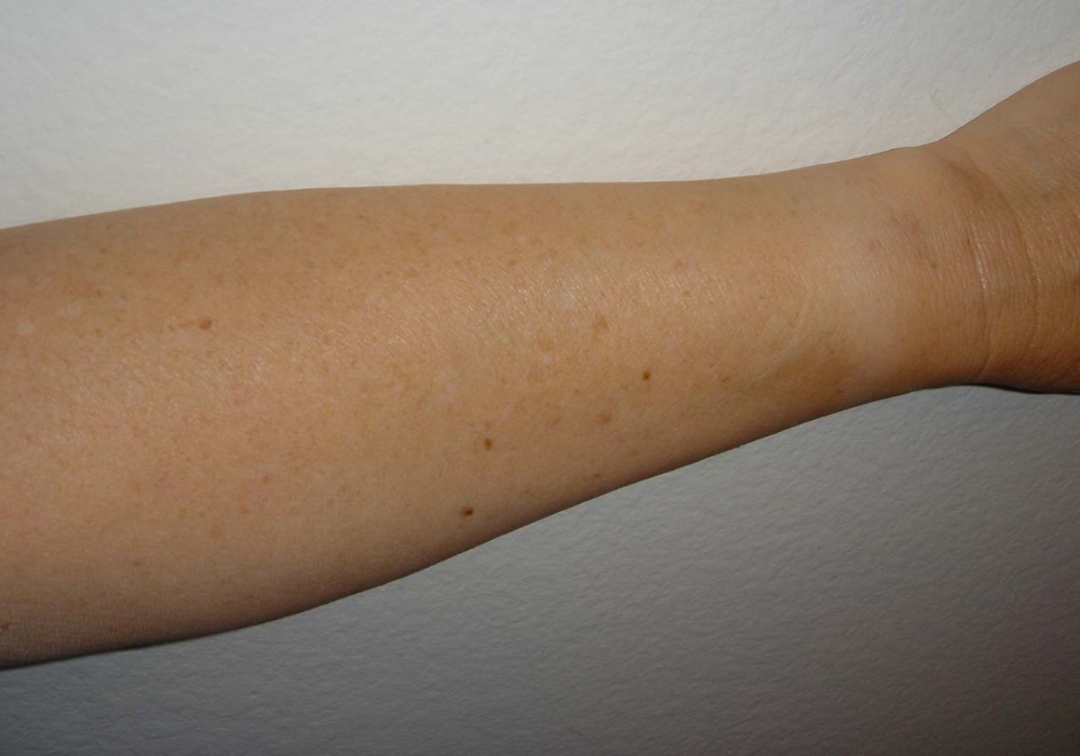 alexandrite-laser-for-treatment-of-sun-damaged-skin