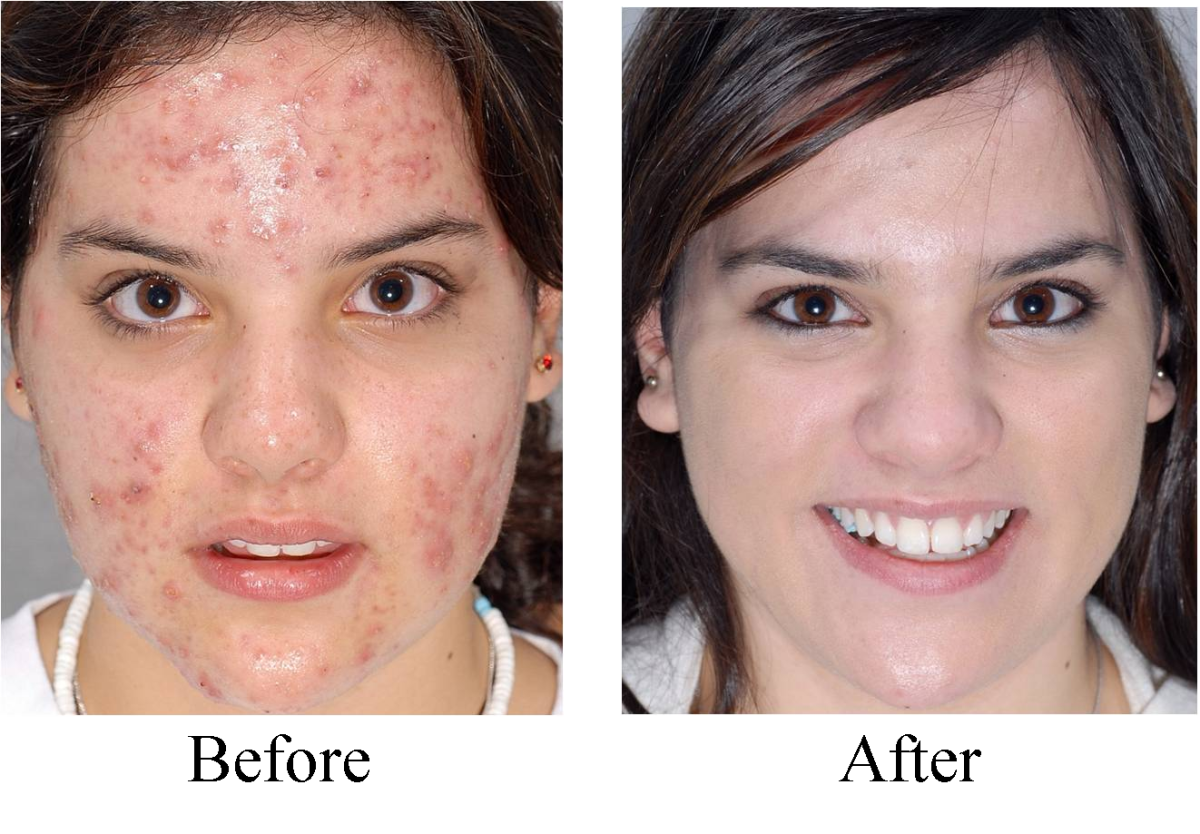 acne scars before and after