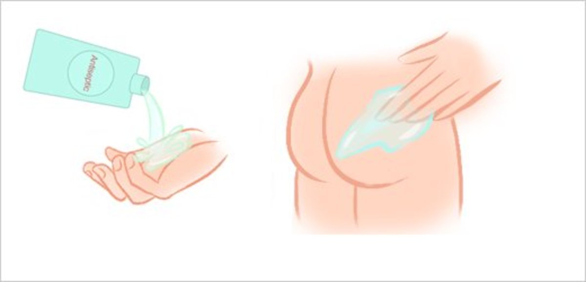 Step 9: Apply Antiseptic to Your Buttocks