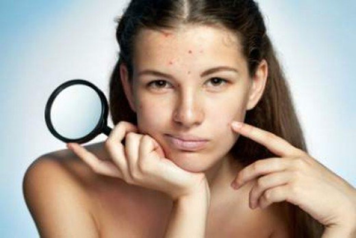 Dealing with acne? There are plenty of steps you can take to help you ease it.