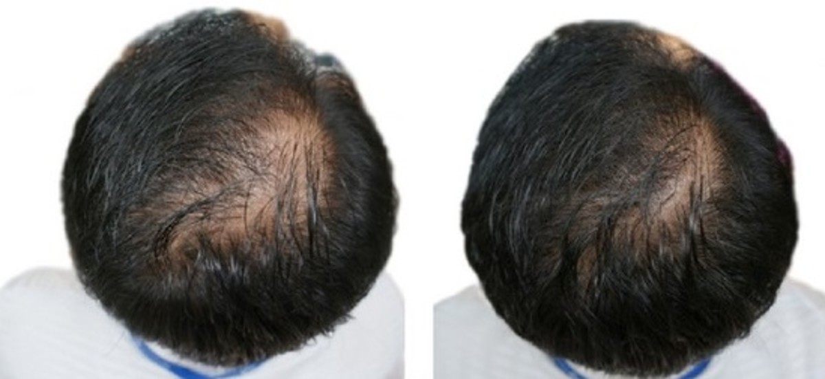 Results after 24 weeks of using Pumpkin Oil topically on scalp