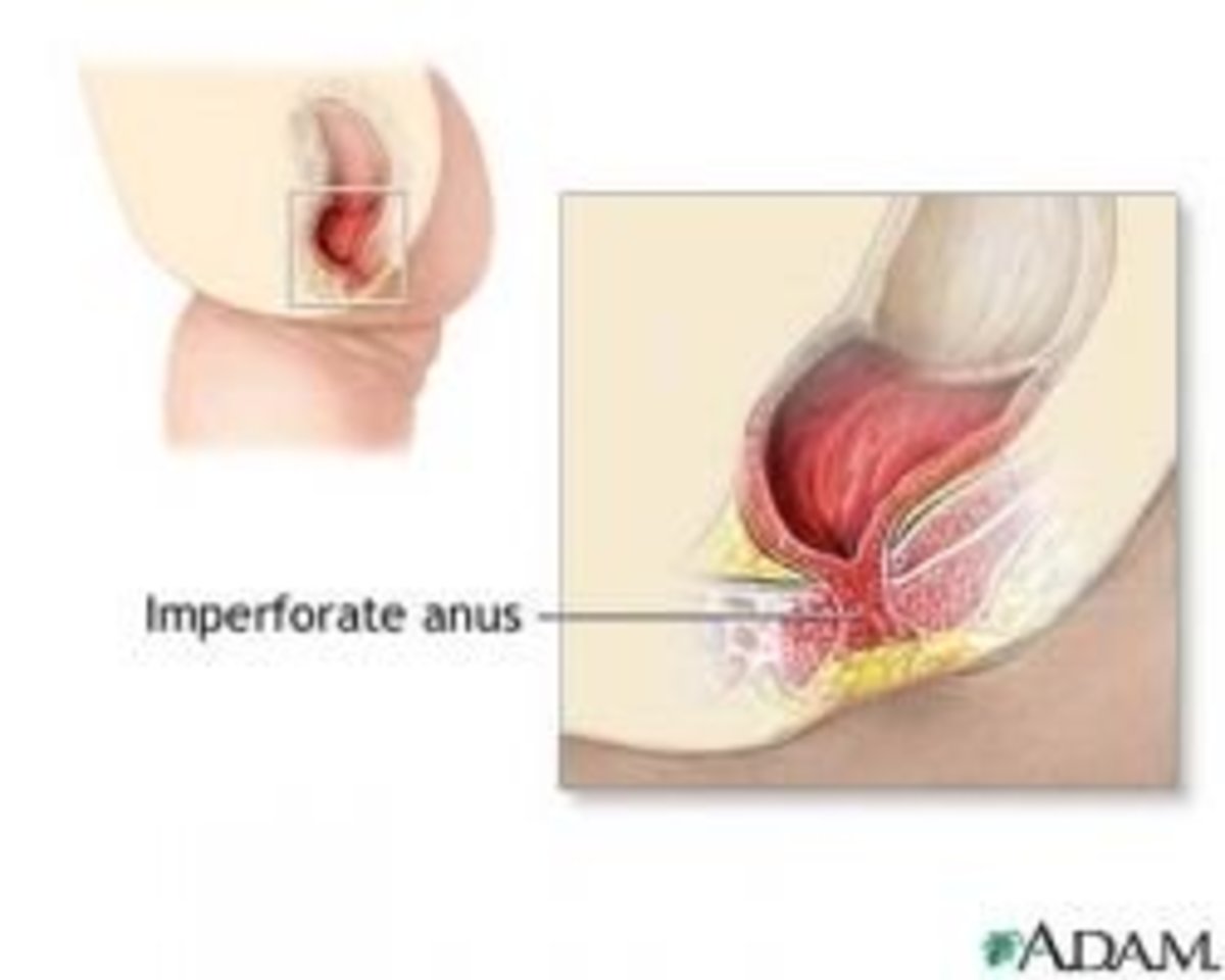 Quite simply, an imperforate anus is when there is no anal opening.
