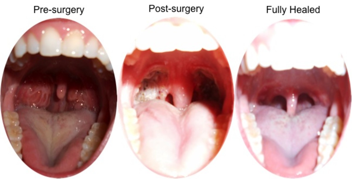 Does My Child Need Their Tonsils And Adenoids Removed WeHaveKids