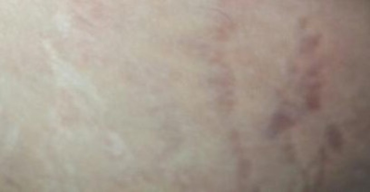 Faded stretch marks next to new stretch marks on skin.