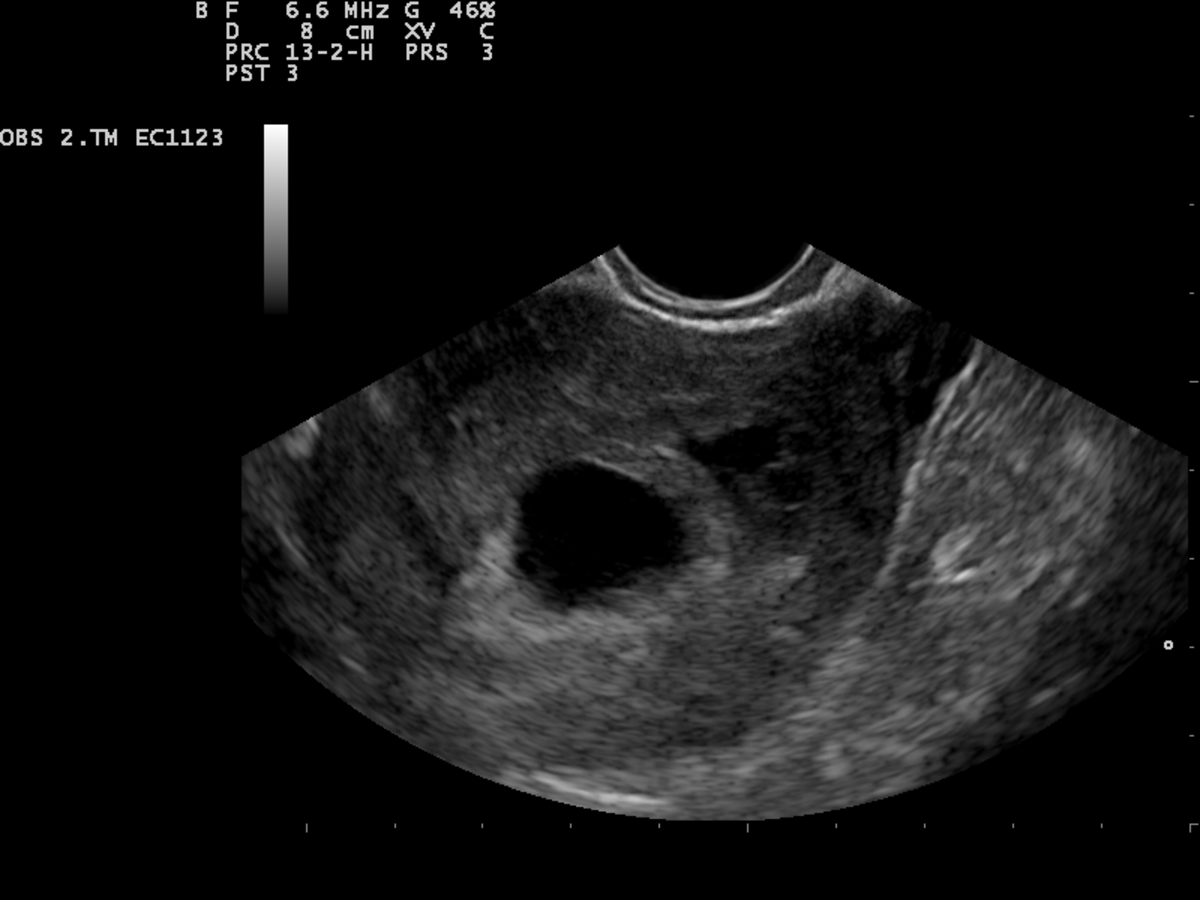 An ultrasound may show an empty gestational sac, which means a miscarriage will occur.