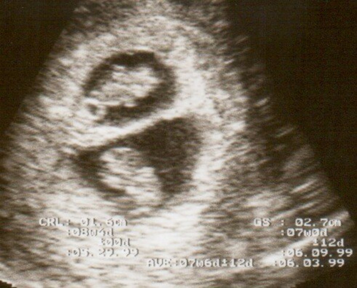 A twin pregnancy at 8 weeks gestation.