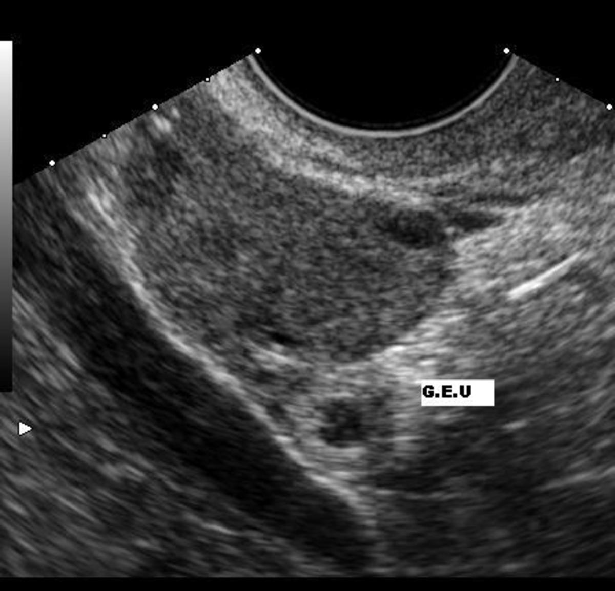 An ectopic pregnancy observed by ultrasound examination.