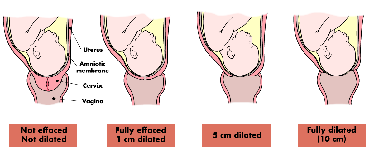 Effacement is the shortening of the cervix; dilation is the opening of its exit.