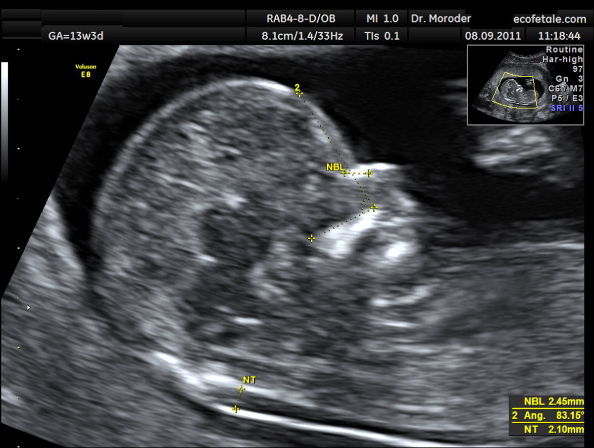 The area of measurement for the  nuchal translucency is noted by the "NT" on the ultrasound.