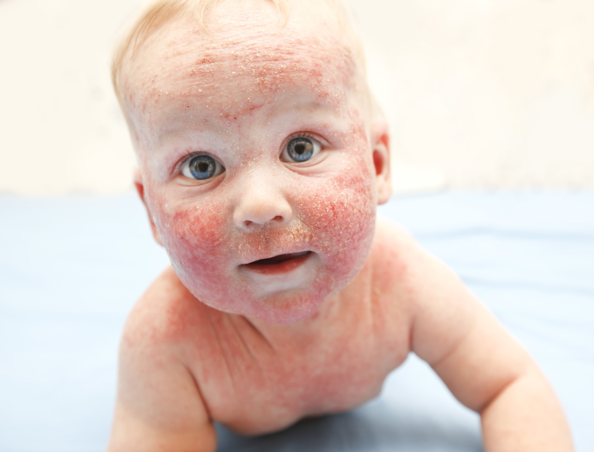 Baby eczema can range from mild to severe and should be treated by your pediatrician or dermatologist. 