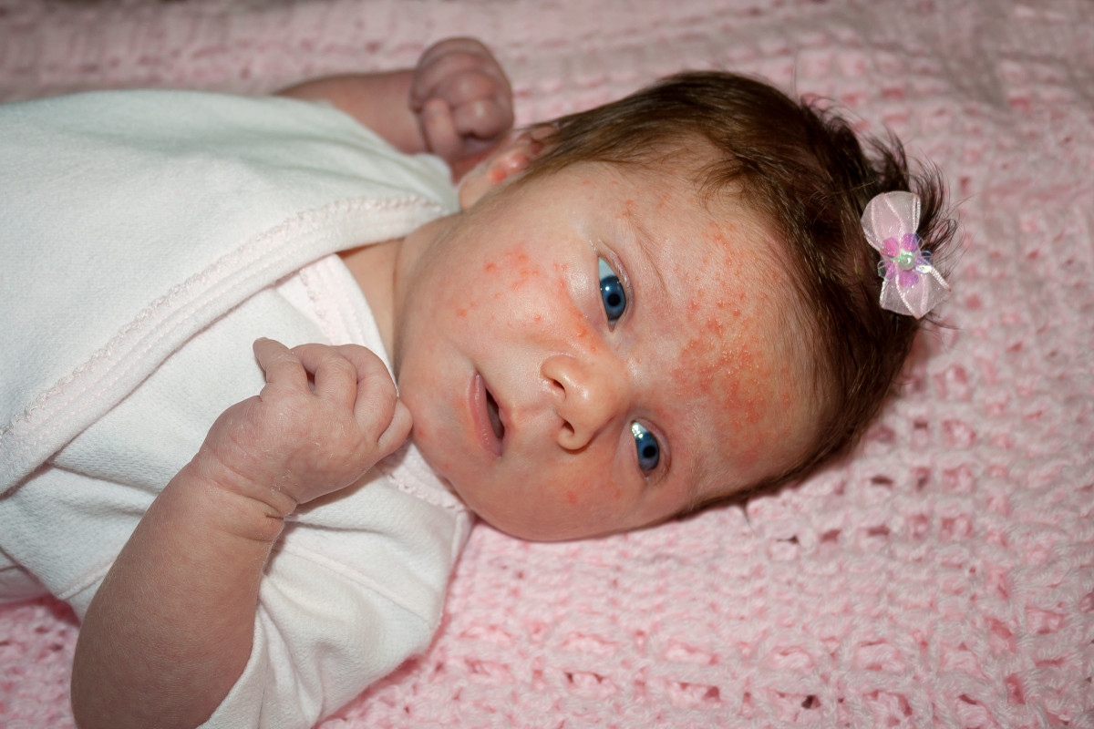 Baby acne is benign and temporary. 