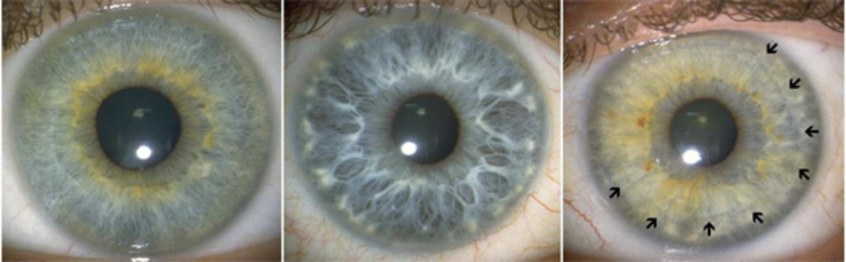 Below image:  “Left: A smoothly textured iris with no crypts (gaps) between the fibers. Center: A loosely textured iris with a  large number of crypts. Right: Arrows indicate a contraction furrow extending part way around the iris.”