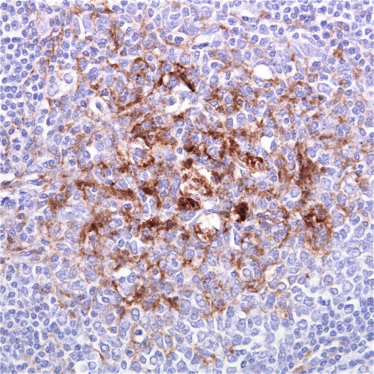 Stained clumps of prions in tonsil tissue from a vCJD patient