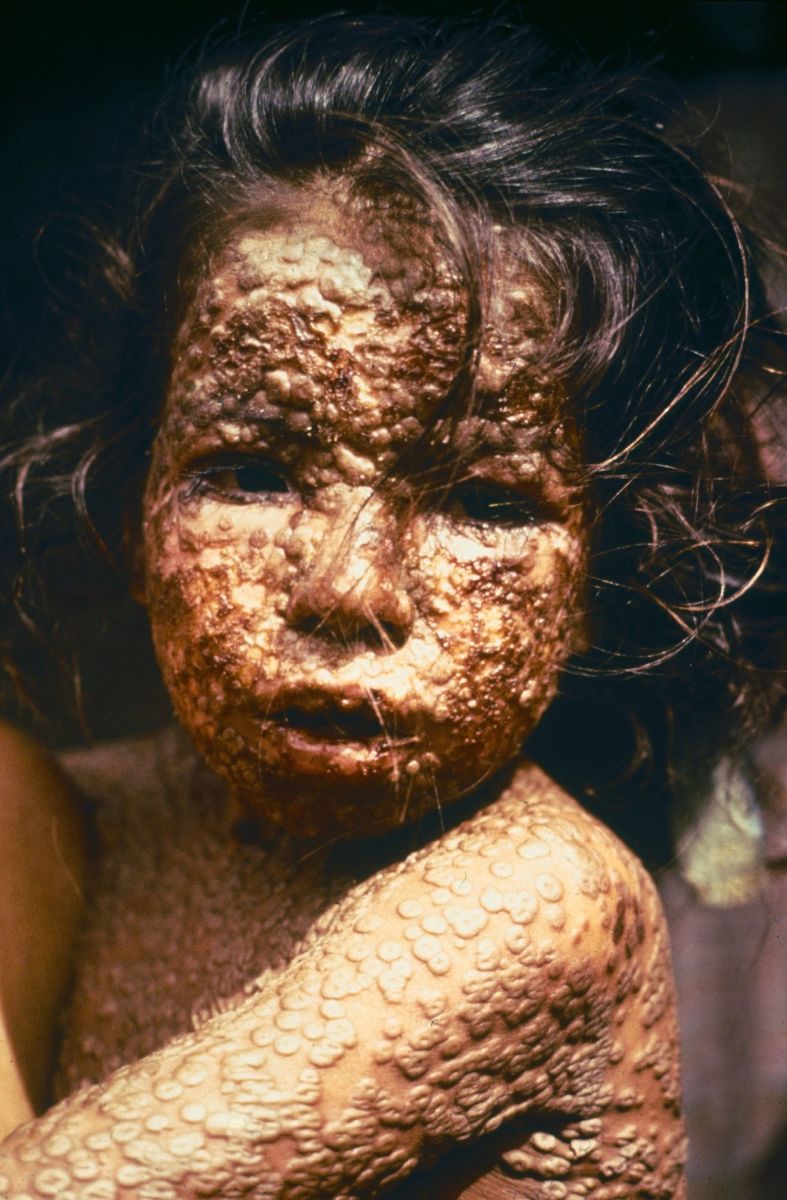 small pox as seen on a child...