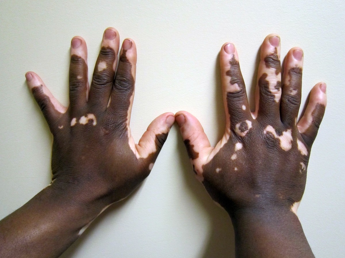 An example of vitiligo in the hands