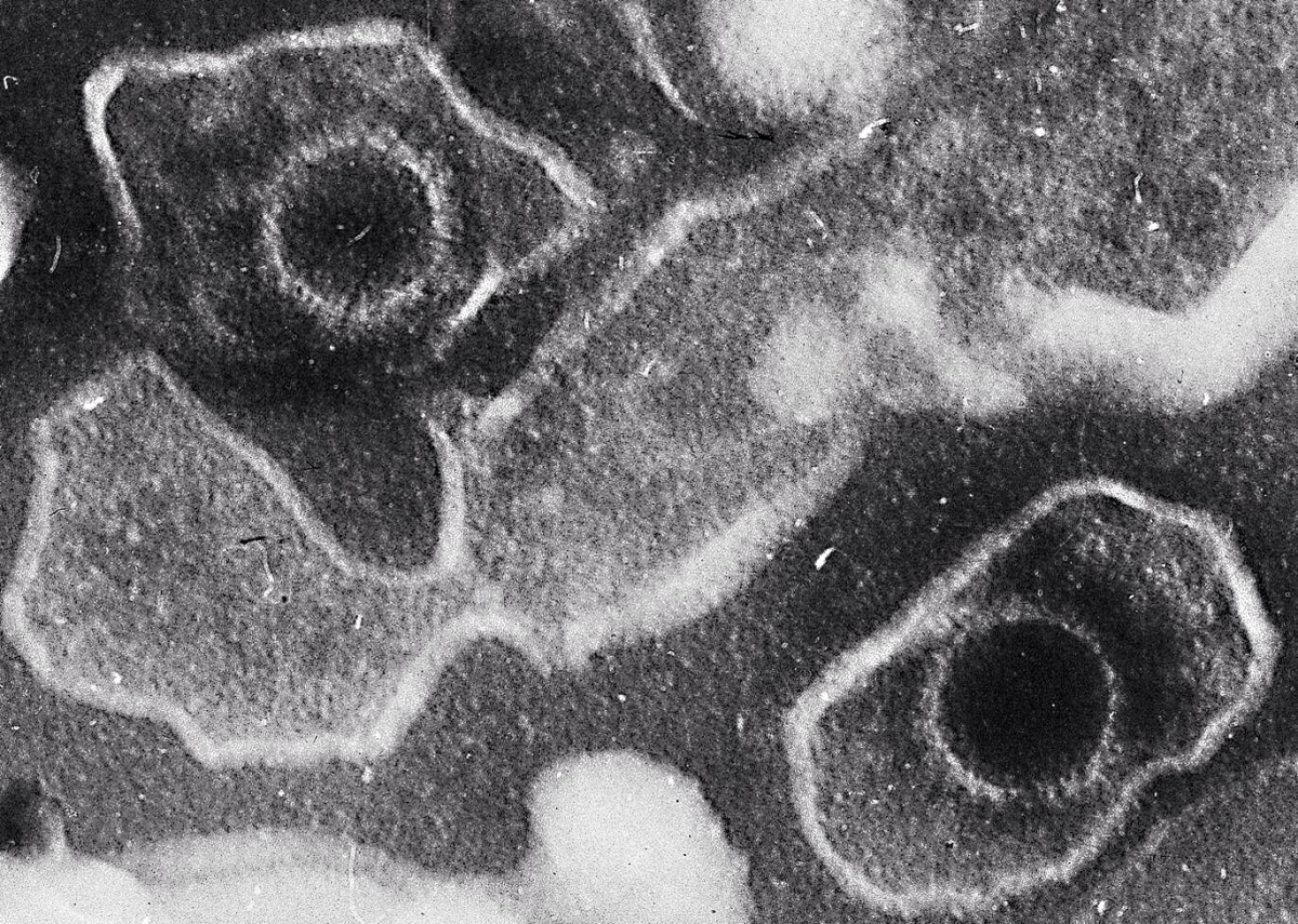 Two Epstein Barr virions (virus particles) on the top left and bottom right of the photo; this virus has been linked to multiple sclerosis