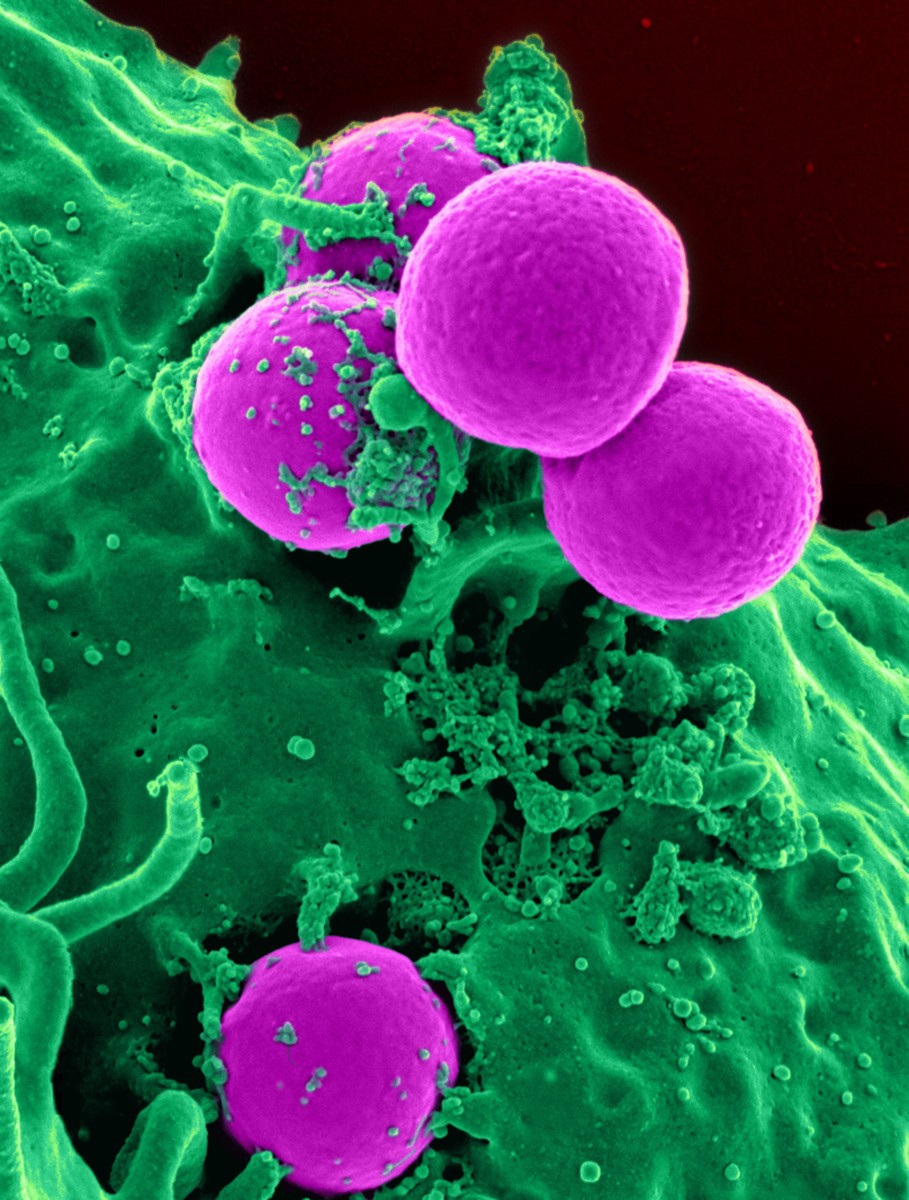 A colourized photo taken with a scanning microscope showing neutrophils (a type of white blood cell) engulfing MRSA bacteria