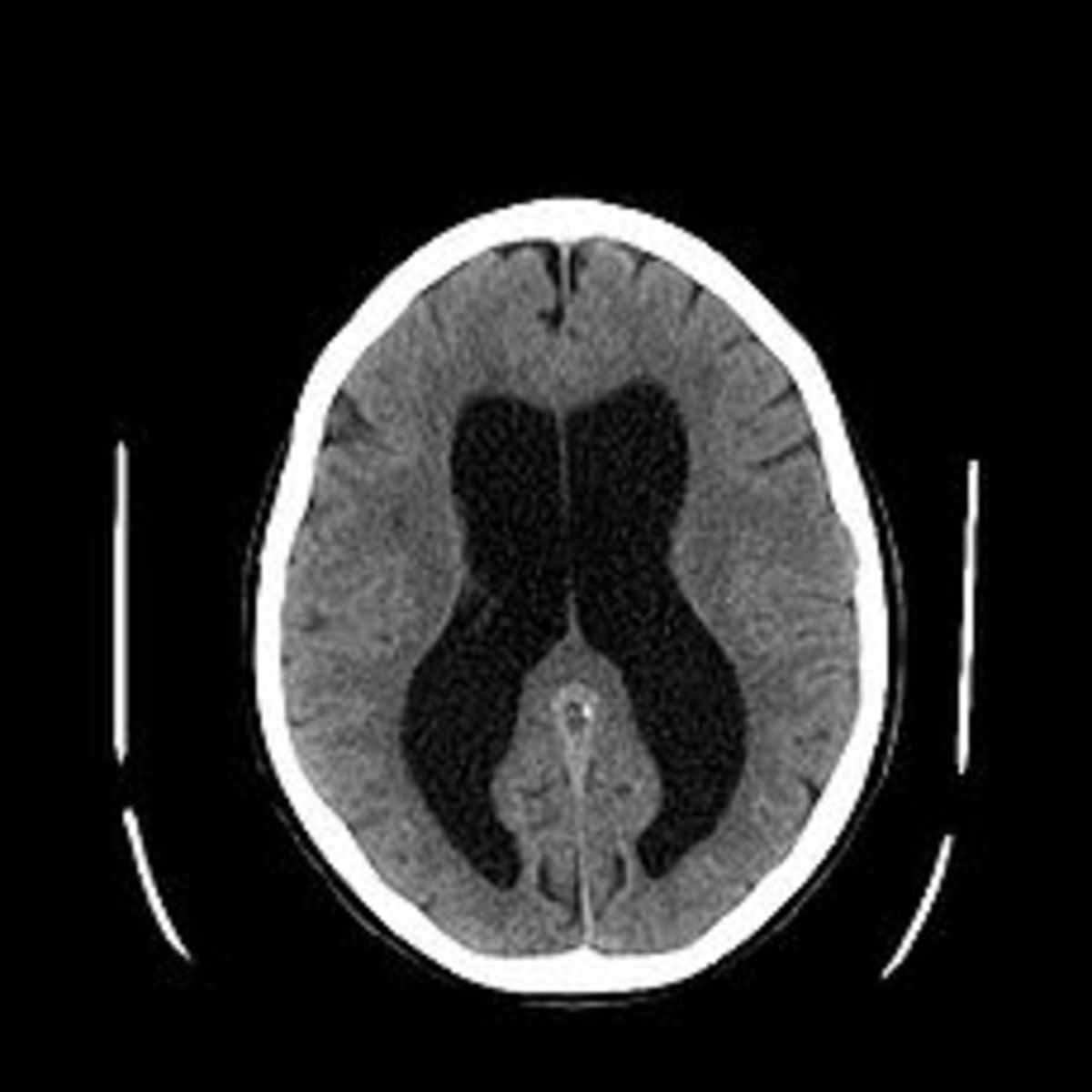 Hydrocephalus seen on a CT scan of the brain. The black areas in the middle of the brain are abnormally large and filled with fluid