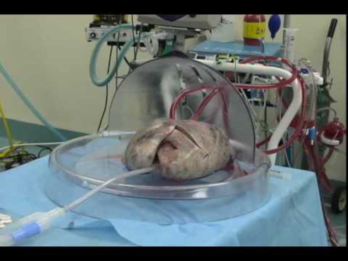 Donor Lungs in a Treatment Bubble. This process takes only three to four hours.