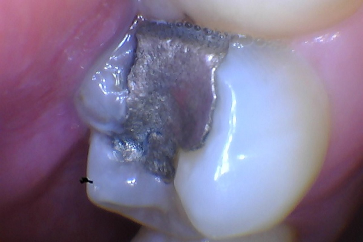 Rare filling material in Katie Poirier’s tooth helped in her identification. 