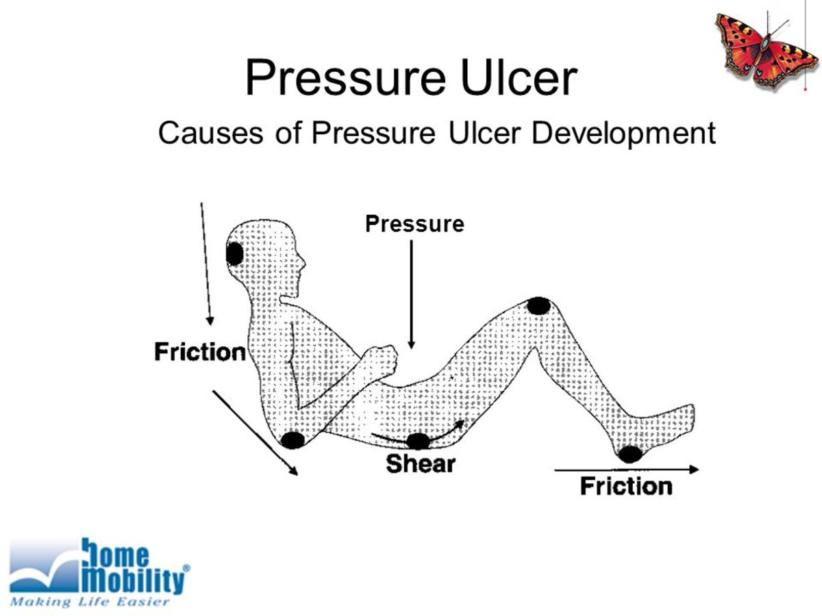 pressure-ulcers