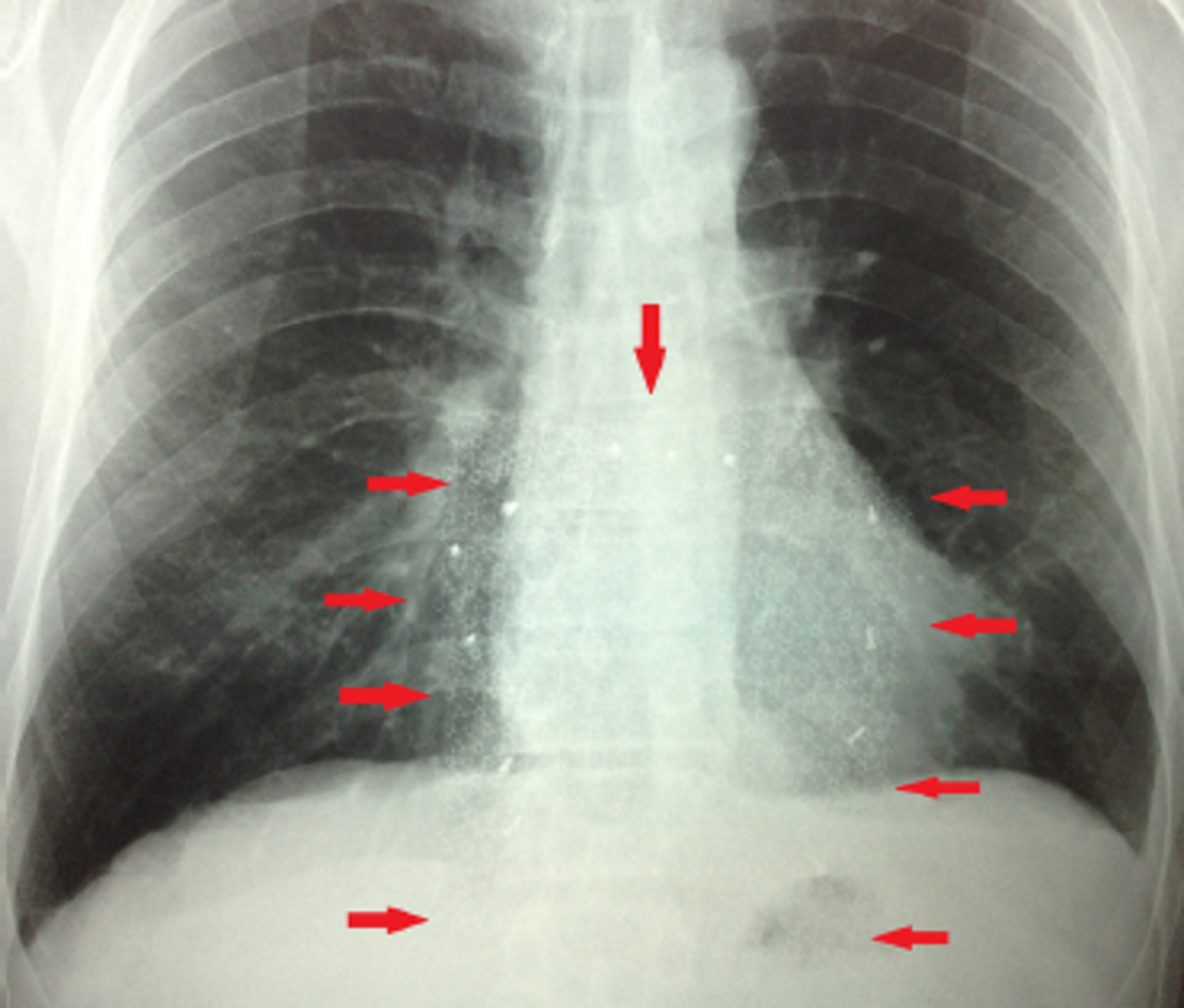 Surgical mesh can be seen during x-rays.