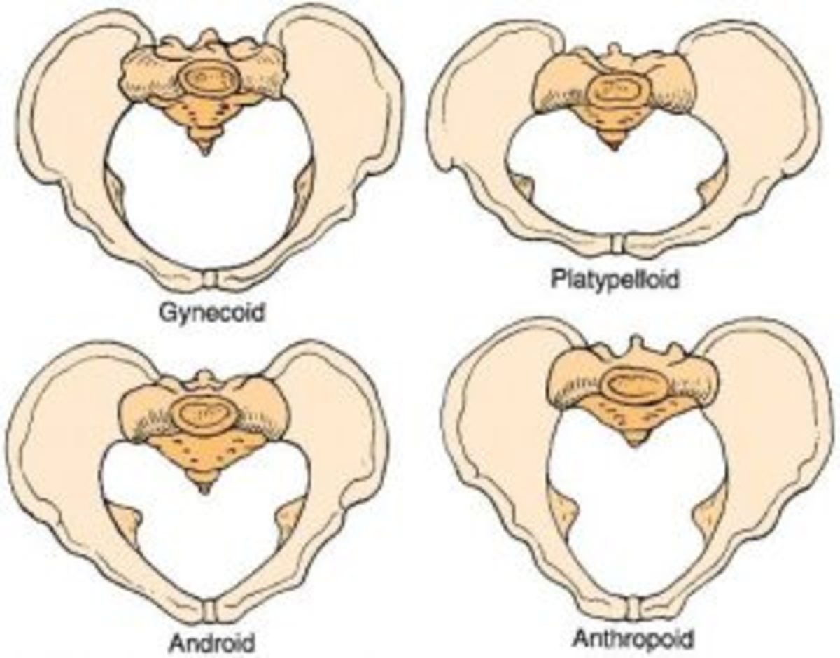 Four alternative female pelvic shapes. Android is considered the most masculine of the female pelvis and is least desirable for childbirth 