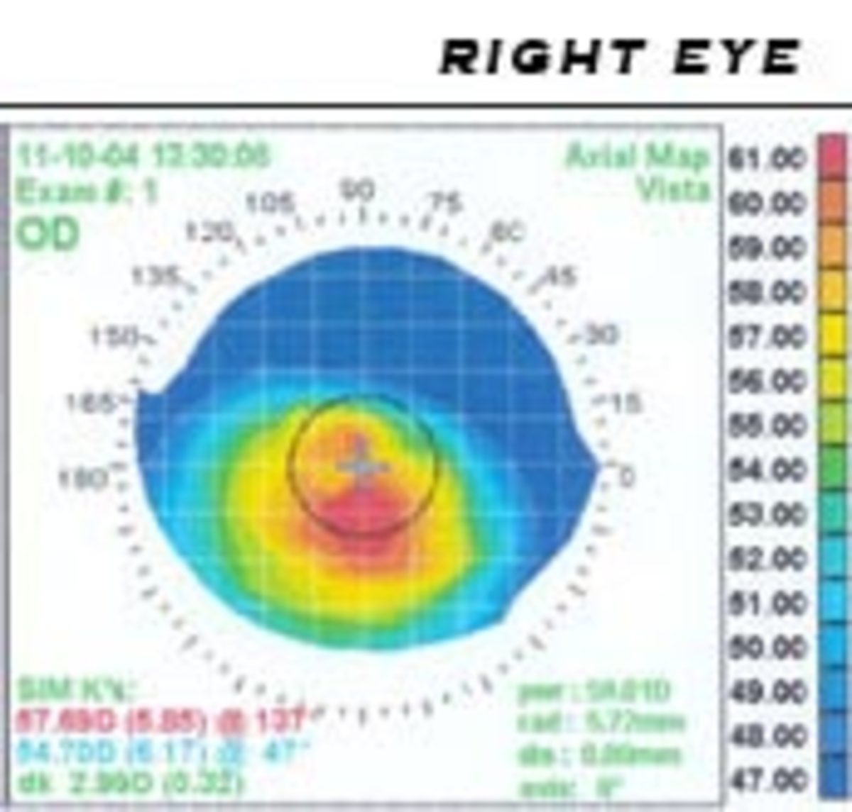 A map of a patient's cornea. The area in red is the location of the astigmatism.